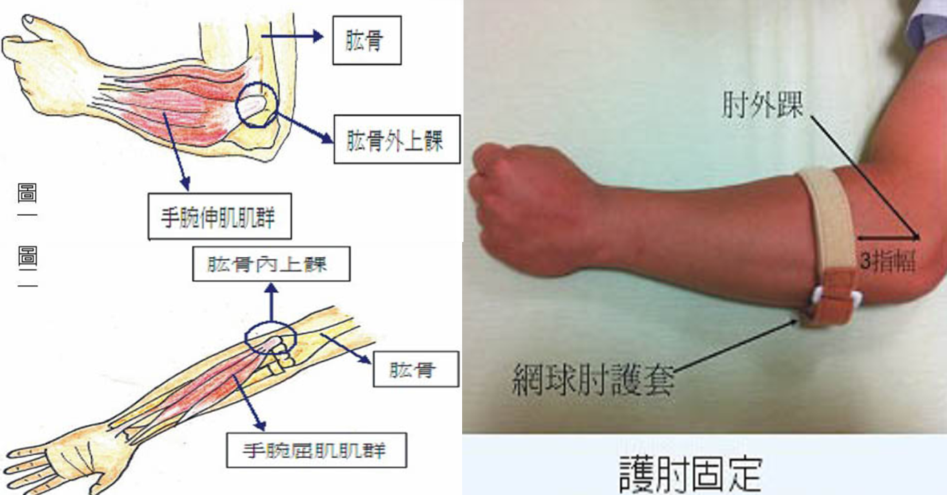 提重物雙手就會皮皮剉？當心「網球肘」和「高爾夫球肘」找上門