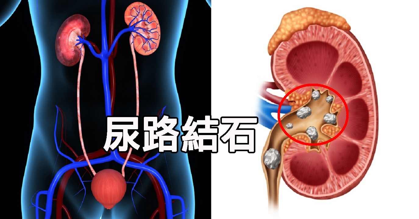 「尿路結石」要限鈣、禁食草酸？答案太驚人！醫師親授「5大抗石
