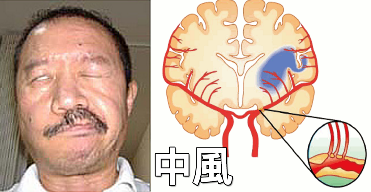一起床就運動更易「中風」?戳破台灣人3大「中風迷思」,這樣做
