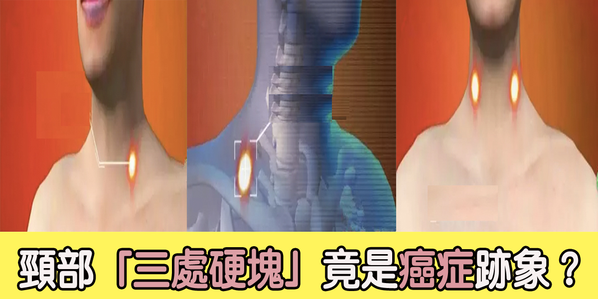 不可大意!「頸部這三處」出現腫塊,竟是癌症跡象?|每日健康H